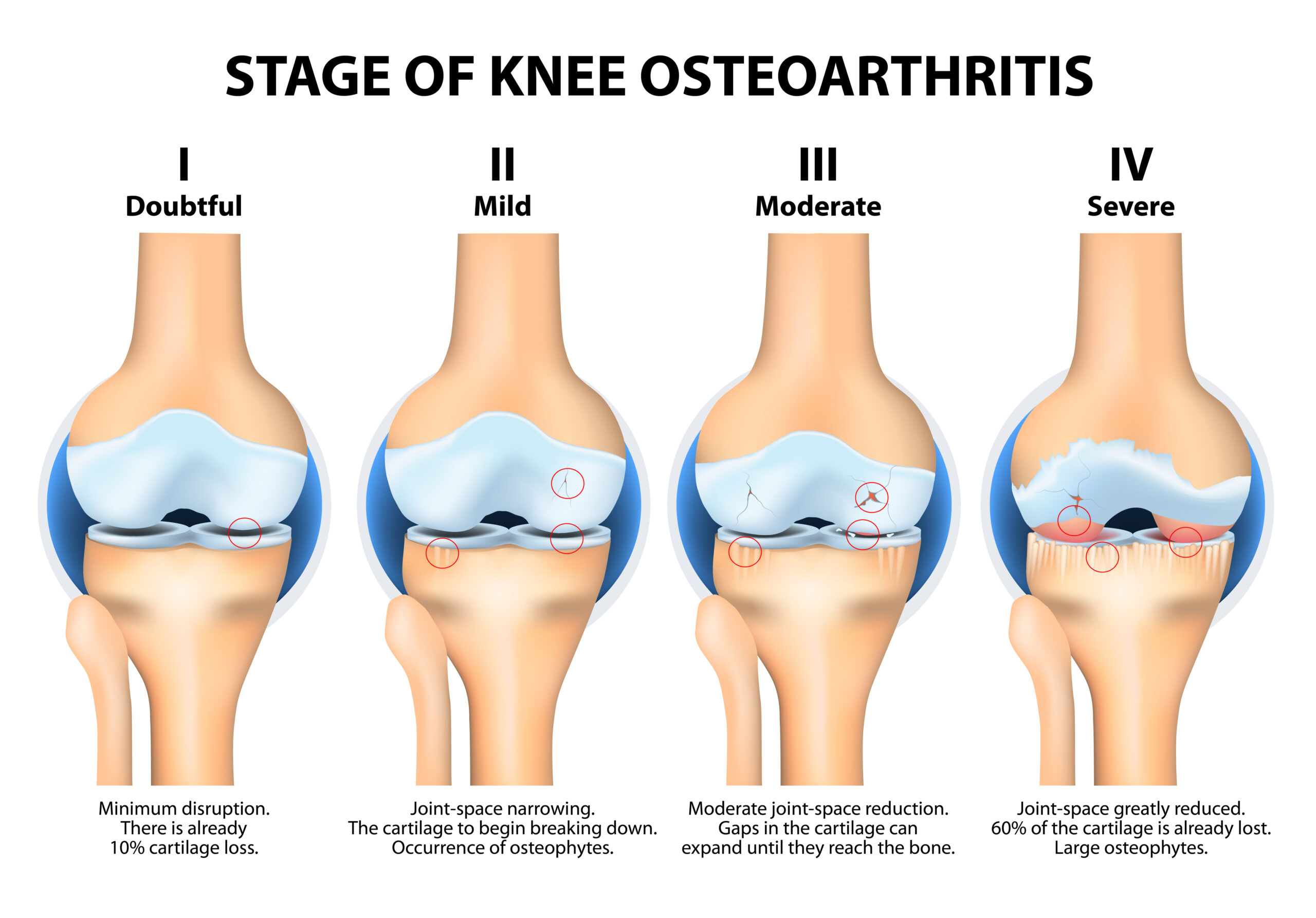 Stages of knee degeneration and osteoarthritis.